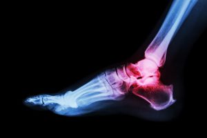 What Does Arthritis in the Ankle Feel Like? - footsurgeon