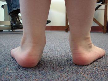 Hyperpronation Flat Feet